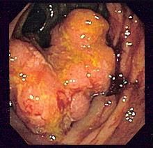 Crohn's disease patients